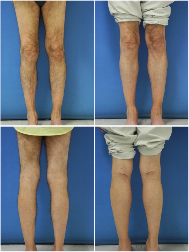 Calf Implants Dr. G Cosmetic Surgery