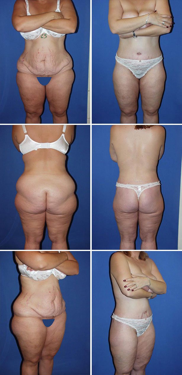 Patient 176763660  Tummy Tuck Revision by Dr. Booth Before