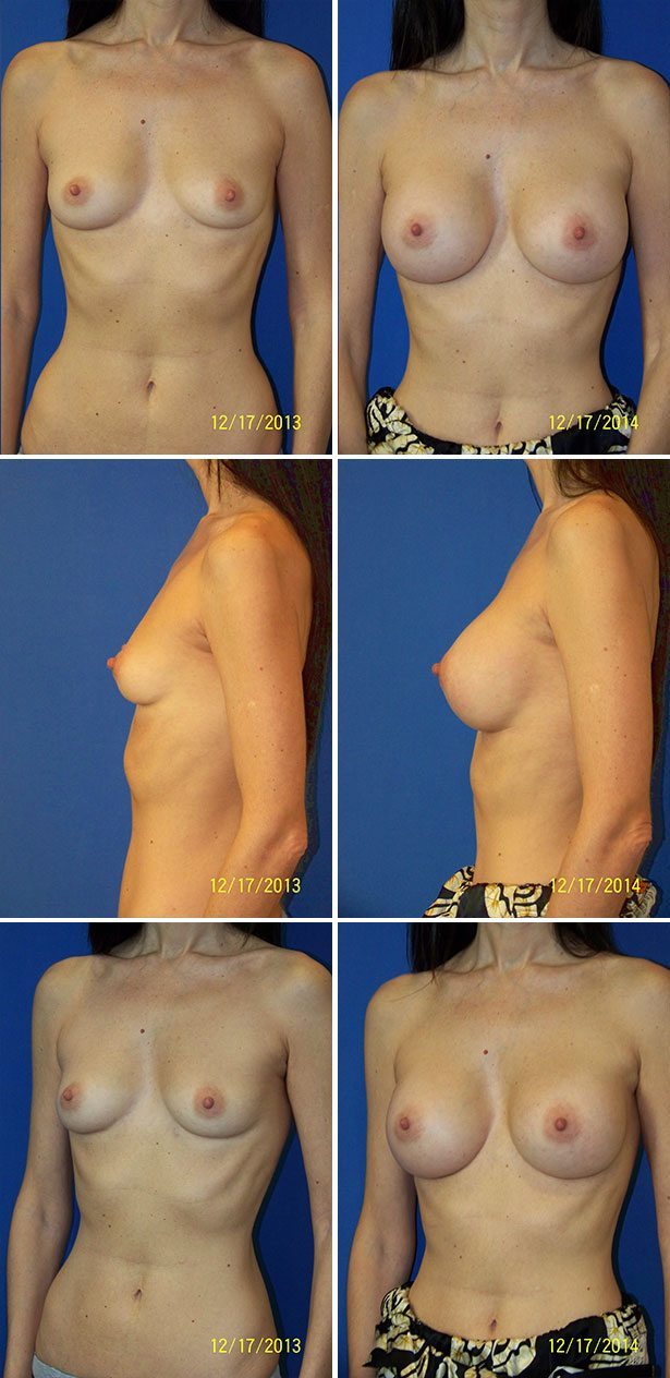 Breast Augmentation Pictures In Florida 63