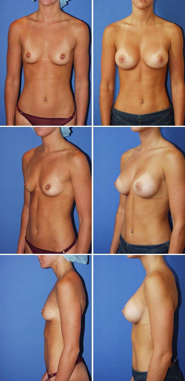 Breast Augmentation Pictures In Florida 13