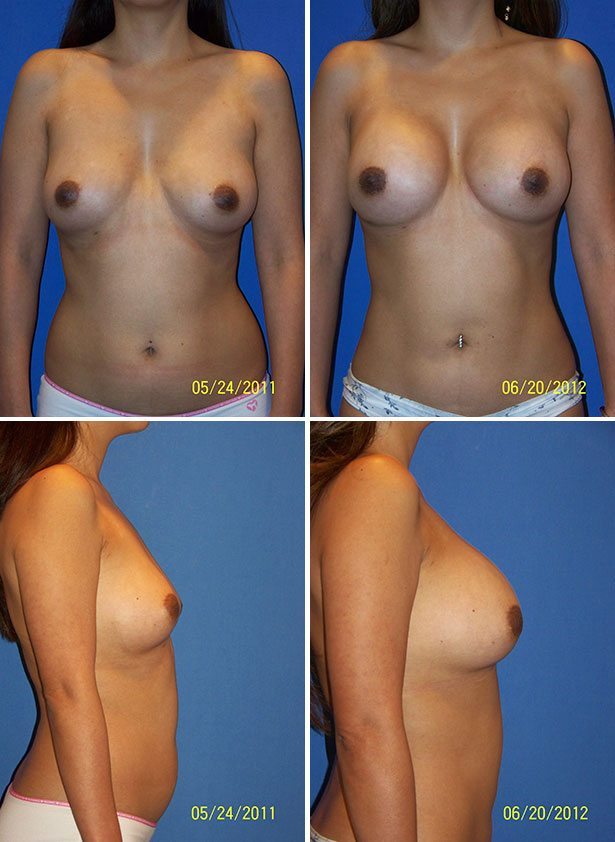 Breast Augmentation Pictures In Florida 108