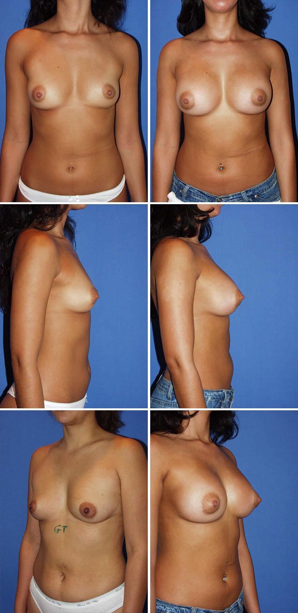 Breast Augmentation Before & After Photo - Case 119.