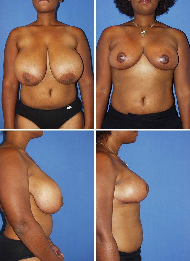 breast-reduction-before-and-after-pics