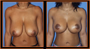 Breast Reduction Miami, Dr. G Cosmetic Surgery