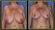 Miami Breast Reduction Surgery - Before & After Photos - Dr. Gershenbaum