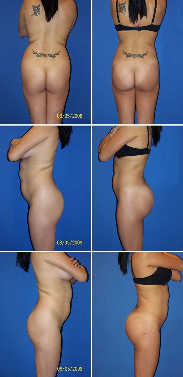 Miami Butt Implants Before & After Photos