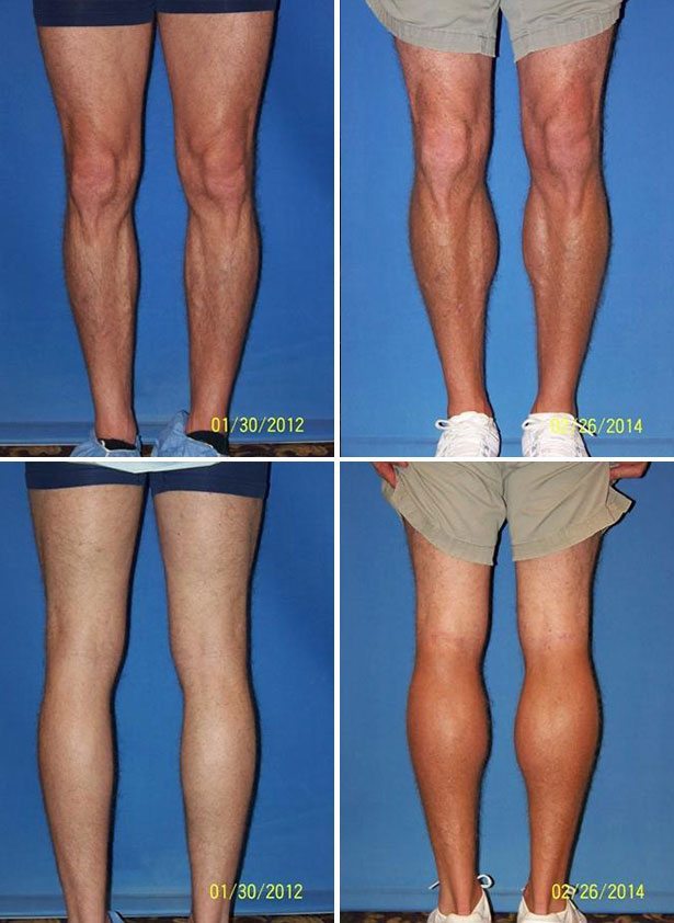 Calf Implants - Dr. G Cosmetic Surgery