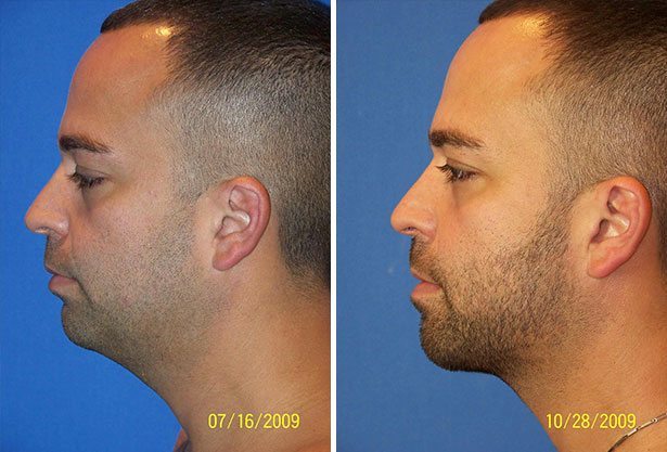 Neck Liposuction - Dr. G Cosmetic Surgery