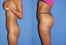 Buttock Implants Miami - Gluteoplasty