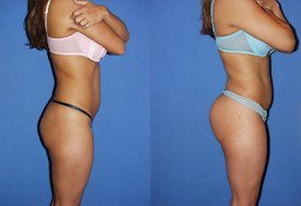 Butt Implants Miami - Buttocks Implants (Gluteoplasty)