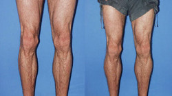 Calf Implants: Surgery, Recovery, Side Effects & Scars