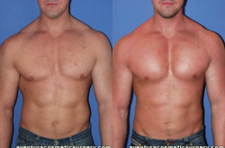 Male Pectoral Implants Miami