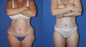 Tummy Tuck Miami, Abdominoplasty