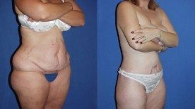 Redefine Your Outlines With a Tummy Tuck in Miami