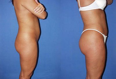 Brazilian Butt Lift Before & After Photos