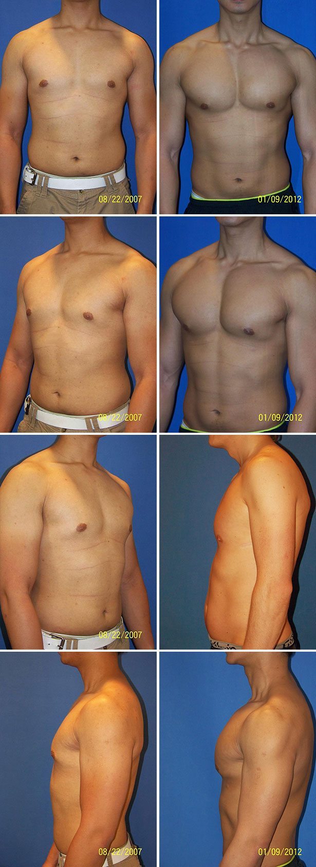 Male Pectoral Implants Before & After Photos