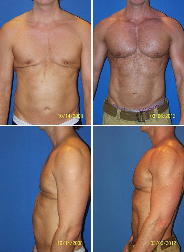 Male Pectoral Implants Before & After Photos