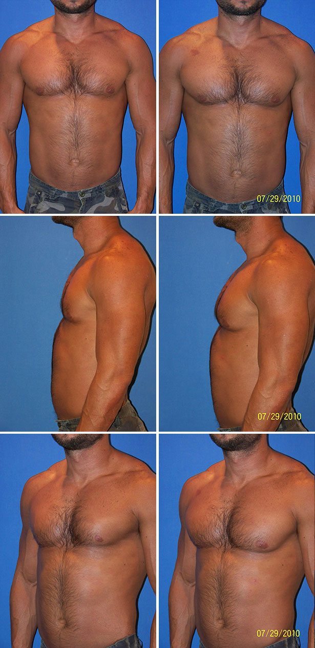 Pectoral Implants - Pecs, Male Chest Reconstruction, Male Plastic