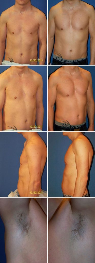 He has a history of corrective surgery for pectus excavatum. 