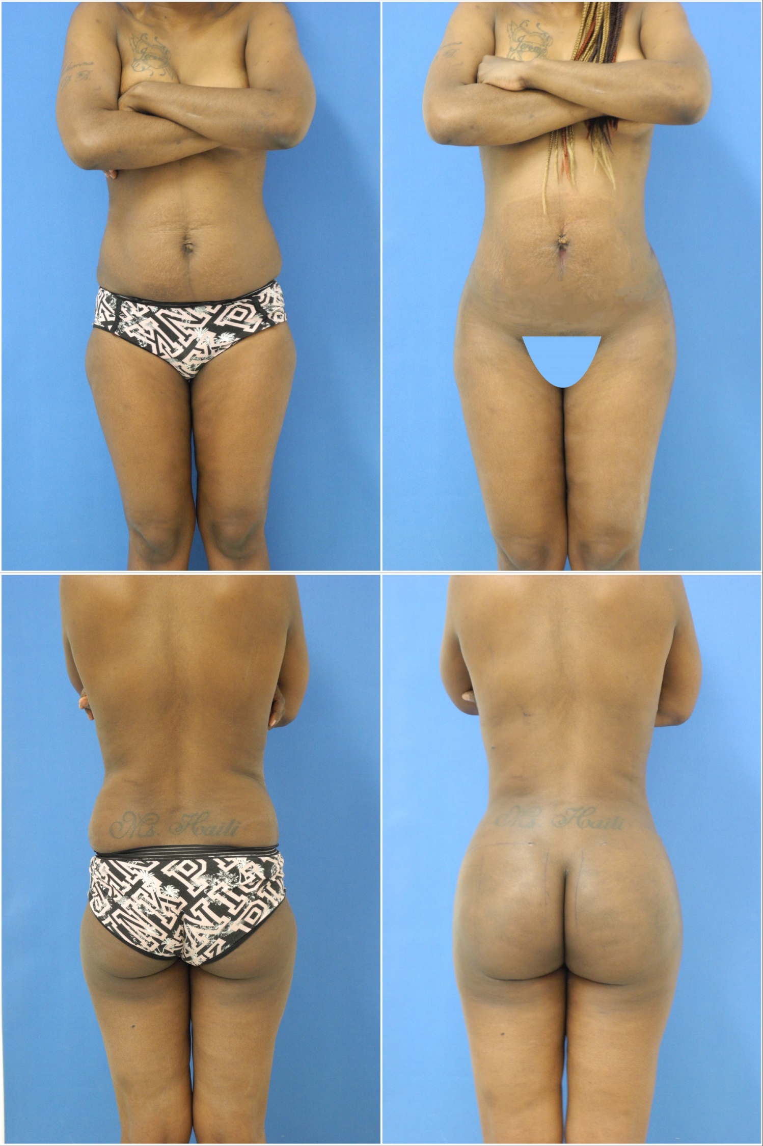 Liposculpture and Liposuction Before and After