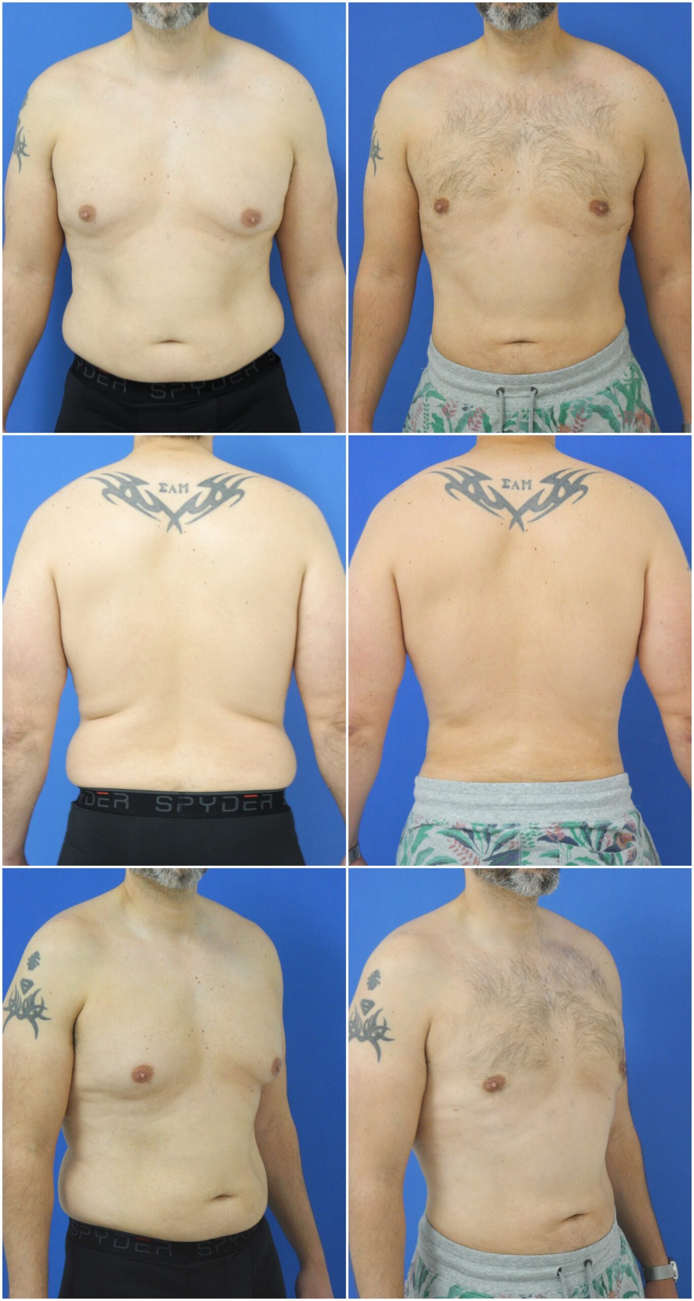 Liposuction - Dr. G Cosmetic Surgery