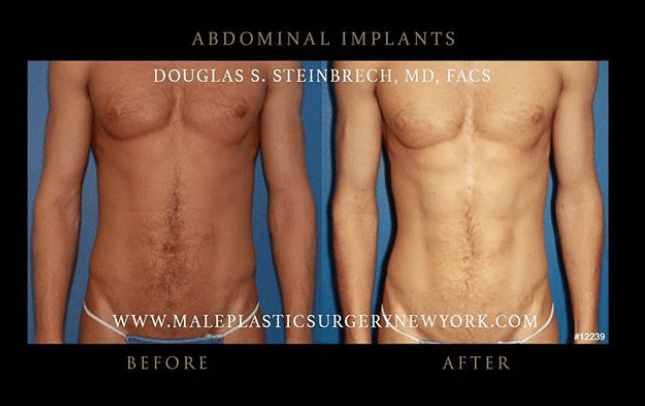 1746555702 ab implants 1 ‘Gym Selfies’ Driving Surge In Male Implants