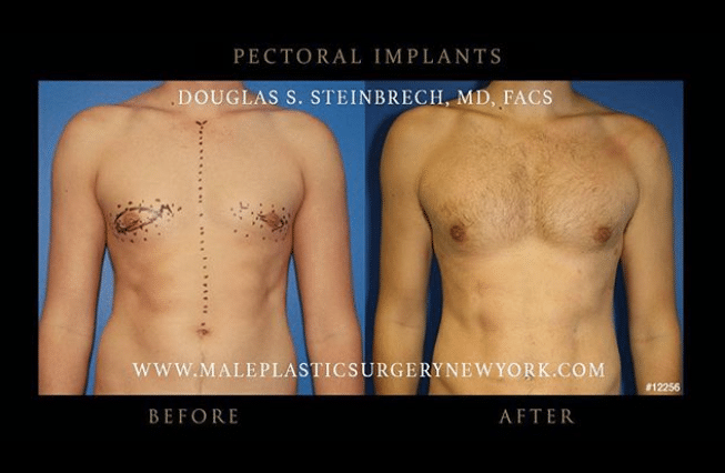 1746555714 pec implants 1 ‘Gym Selfies’ Driving Surge In Male Implants