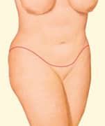1746555834 body lift 02 2 1 Post-Bariatric Weight Loss Consultation