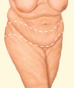 1746555844 body lift 01 1 Post-Bariatric Weight Loss Consultation