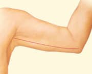 1746555861 arm lift 02 6 1 Post-Bariatric Weight Loss Consultation