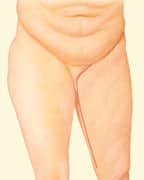 1746555873 thigh lift 02 8 1 Post-Bariatric Weight Loss Consultation