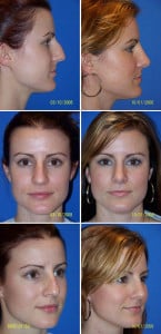 1746556371 rhinoplasty dr gershenbaum miami 104 145x300 1 Rhinoplasty Revision in Miami, FL