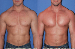 1746556756 drgershenbaum miami florida pectoral implants 250x165 1 Male Pectoral Implants in Miami, FL