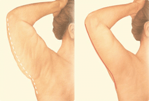 1746555803 drgershenbaum armlift procedures2 2 1 Arm Lift in Miami, FL