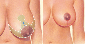 1746556250 Breast Reduction 5 1 Breast Reduction in Miami, FL