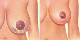 1746556254 Breast Reduction 6 1 Breast Reduction in Miami, FL