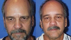 1746556339 drgershenbaum browlift procedures 250x140 1 1 Brow Lift in Miami, FL