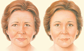 1746556351 drgershenbaum browlift classic1 1 1 Brow Lift in Miami, FL