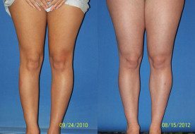1746556773 drgershenbaum 52506 calf implants 276x190 2 1 Calf Implants in Miami, FL