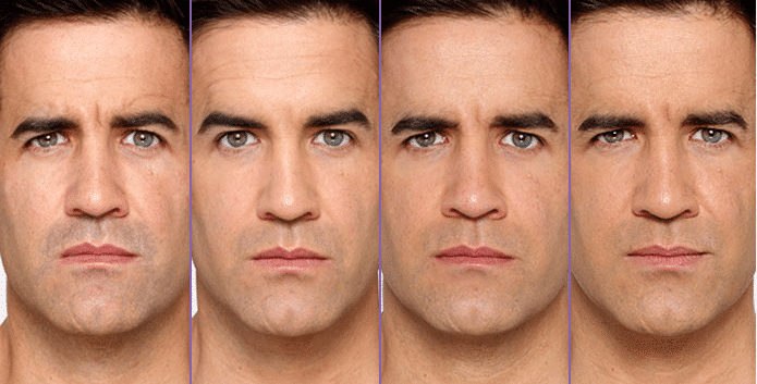 Botox2-1 Botox2 1 Botox in Miami, FL