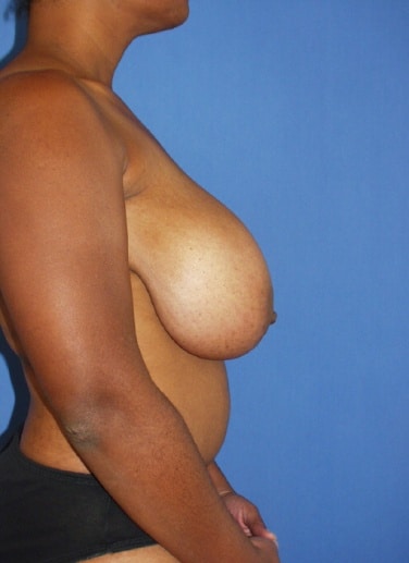 Breast Reduction 11 Breast Reduction in Miami, FL