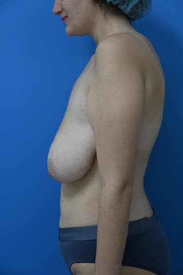 Breast Reduction 7 Breast Reduction in Miami, FL