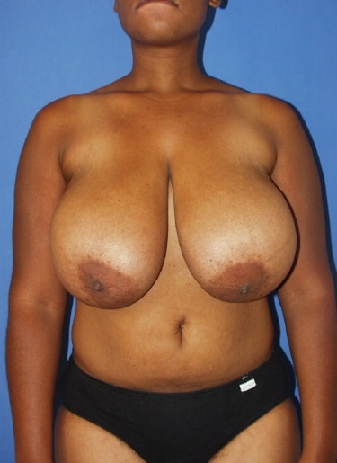 Breast Reduction 9 Breast Reduction in Miami, FL