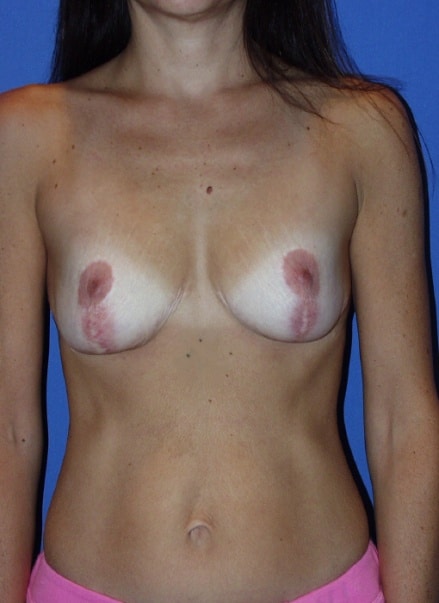 Breast implant revision 11 Breast Implant Revision in Miami, FL