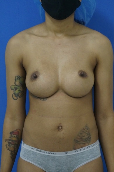 Breast implant revision 7 Breast Implant Revision in Miami, FL
