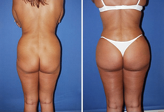 Butt Implants Gluteoplasty Dr. Gershenbaum Miami Butt Implants in Miami, FL