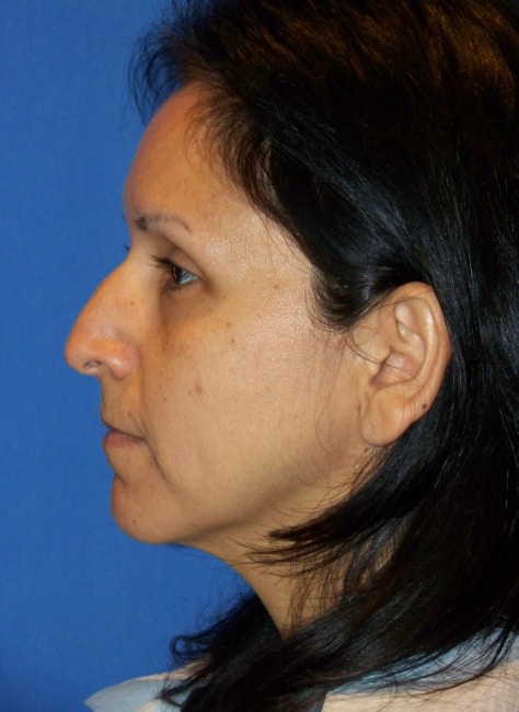 Picture1 Picture1 1 Rhinoplasty in Miami, FL