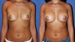 Picture11 Breast Augmentation
