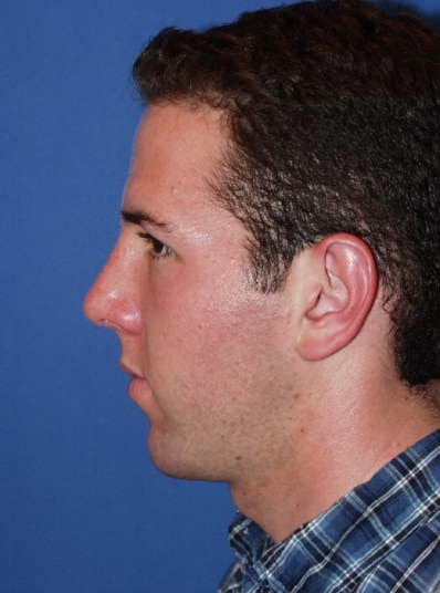Picture4-1 Picture4 1 1 Rhinoplasty in Miami, FL