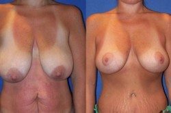 Picture4 Breast Lift in Miami, FL